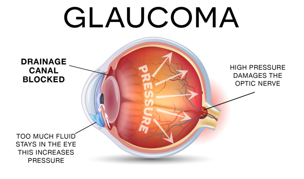 Glaucoma treatment in pune