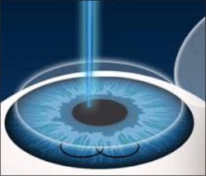 lasik in pune